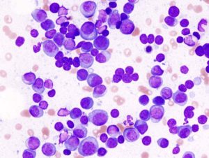 Read more about the article A new and exciting Monoclonal Antibody for Multiple Myeloma: Daratumumab